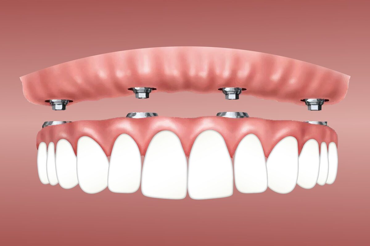 overdenture-3597628_1280-1200x800.jpg